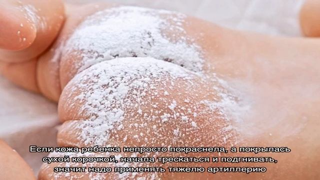 10 частых причин опрелости у новорожденных. Как избавиться от опрелостей? смотреть онлайн