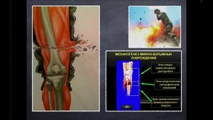 Травматическая ампутация часть 1-1