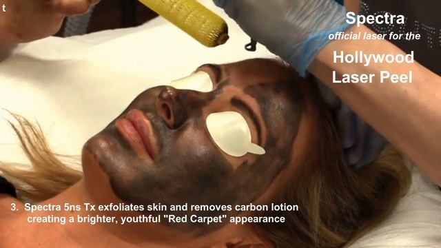 Hollywood (Spectra) Peel - Голливудский карбоновый пилинг смотреть онлайн