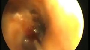 Клиника доктора Коренченко. Лечение. Отомикоз.