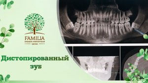 ? Дистопированный зуб