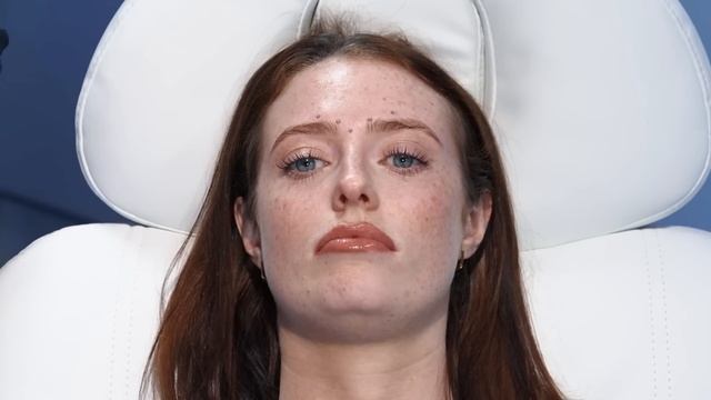 Botox Brow Lift Injection Patterns. Botox Mark-Up Tutorial