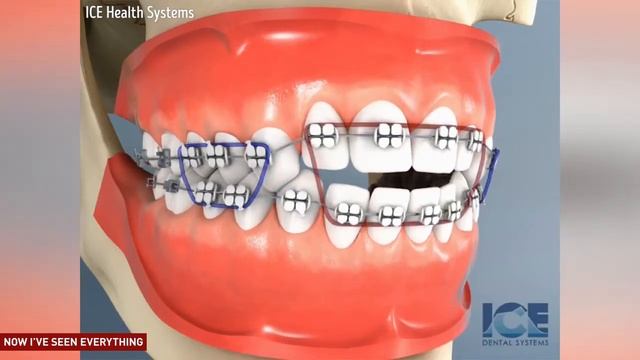 Лечение открытого прикуса на брекет системе с использованием эластичной тяги смотреть онлайн