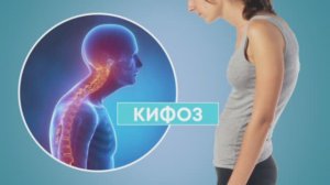 Кифоз
