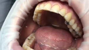 Вкладка из циркония CEREC. Ортопед Церекона - Самсаков Сергей