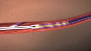 VNUS ClosureFAST Procedure