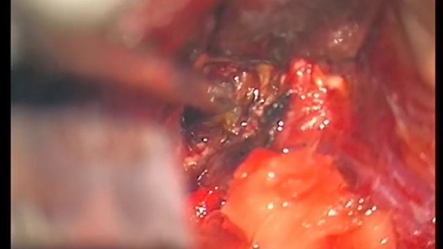 Cerebellar Cavernoma / Кавернома мозжечка