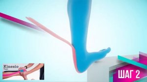 Фиксация ахиллова сухожилия