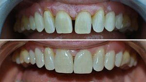 Виниры и люминиры в процессе установки, влог стоматология Самара. Veneer