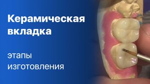 Керамическая вкладка | Изготовление | Этапы