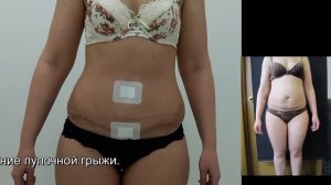 № 103 4, 5 недель после пластика живота, пупочной грыжи и 6 зон липосакции на бёдрах.