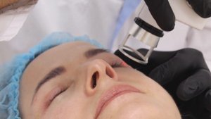 Лазерная Шлифовка Шрама на лице лазером СО2 Coolaser