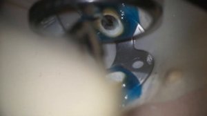 Извлечение сломанного инструмента из корневого канала