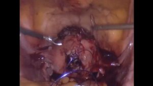 Огромный субсерозный миоматозный узел