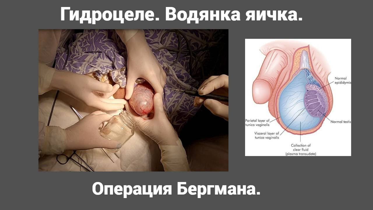 Гидроцеле  Водянка яичка  Операция Бергмана