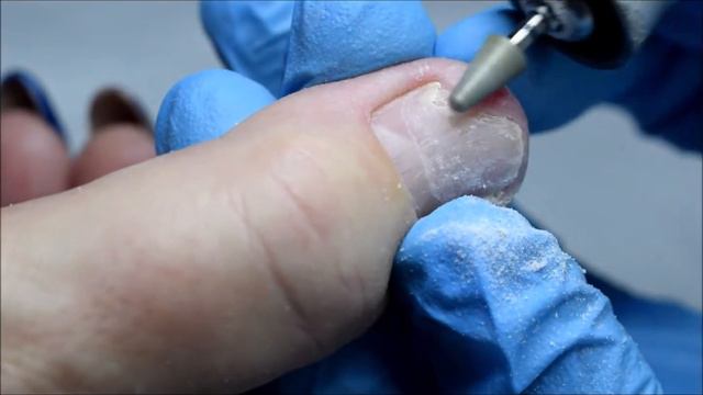 Обработка Онихолизиса смотреть онлайн