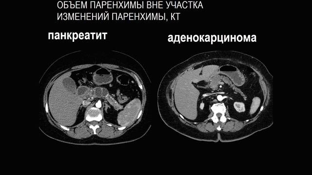 Рак поджелудочной железы Часть 2