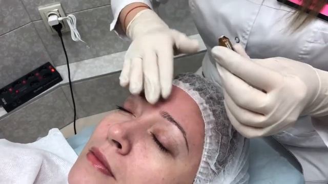 Микронидлинг на аппарате дермапен Mesodevice смотреть онлайн