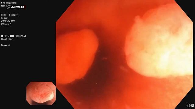 Язвенный колит, левосторонне поражение (проктосигмоидит), выраженная эндоскопическая активность. смотреть онлайн