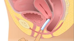 Применение чашечно перфорированного пессария