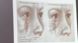 Мешки под глазами причины появления коррекция малярные мешки