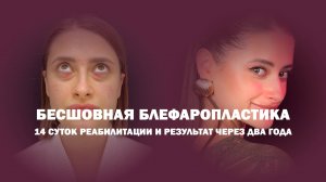 Трансконъюнктивальная блефаропластика