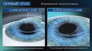 Сравнение первого этапа SUPER FEMTO LASIK от других методов