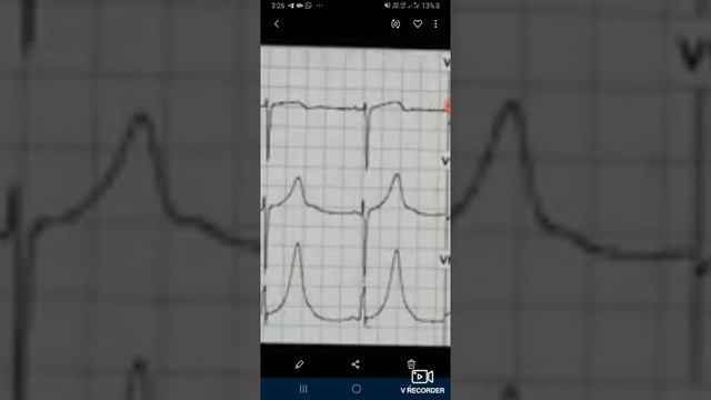 How to read an ECG in malayalam смотреть онлайн