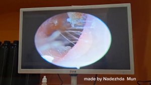 Китай | г. Хуньчунь | Процедура  "Чистка ушей" |