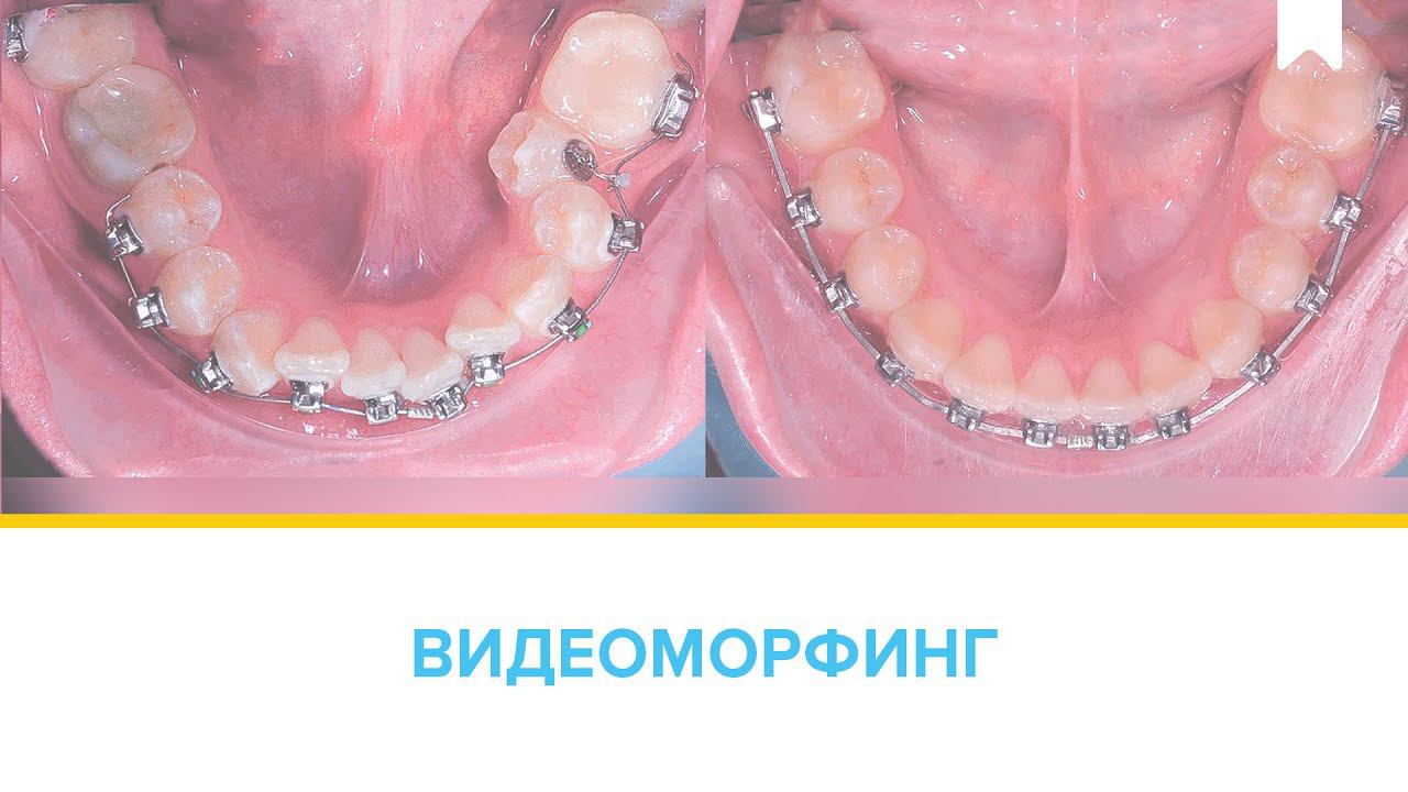 Лечение скученности с удалением цифровыми брекетами INSIGNIA.