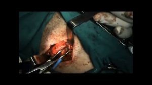 Rzayev R.M. Киста парафарингеального пространства (бранхиогенная киста шеи)