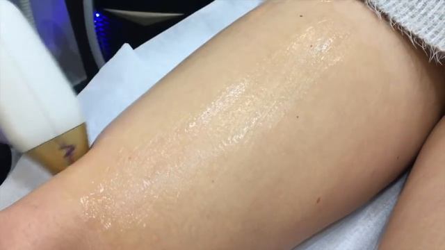 Depilacja laserowa Bydgoszcz Soprano Ice Platinum смотреть онлайн