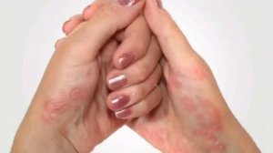 Дерматит, красный лишай!Как вылечить в домашних условиях  контактный дерматит красный лишай?