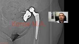 Вывих протеза тазобедренного сустава. Ролик №72