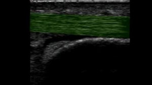 Musculoskeletal Ultrasound: Ankle 7: posterior longitudinal scan