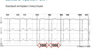 Холтеровское мониторирование пациентов с электрокардиостимуляторами