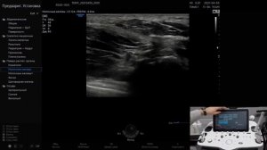 Технология ElastoScan - эластография