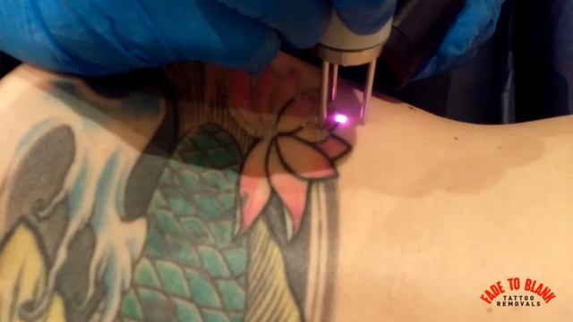 Losing Nemo - My Tattoo Removal Journey with Quanta Q-Plus C смотреть онлайн