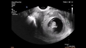 Субхориальная гематома