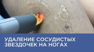 Удаление сосудистых звездочек на лазере Cutera XEO в клинике "Консилиум"