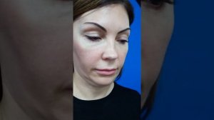 Пациентка до КРУГОВОЙ ПЛАСТИКИ ЛИЦА