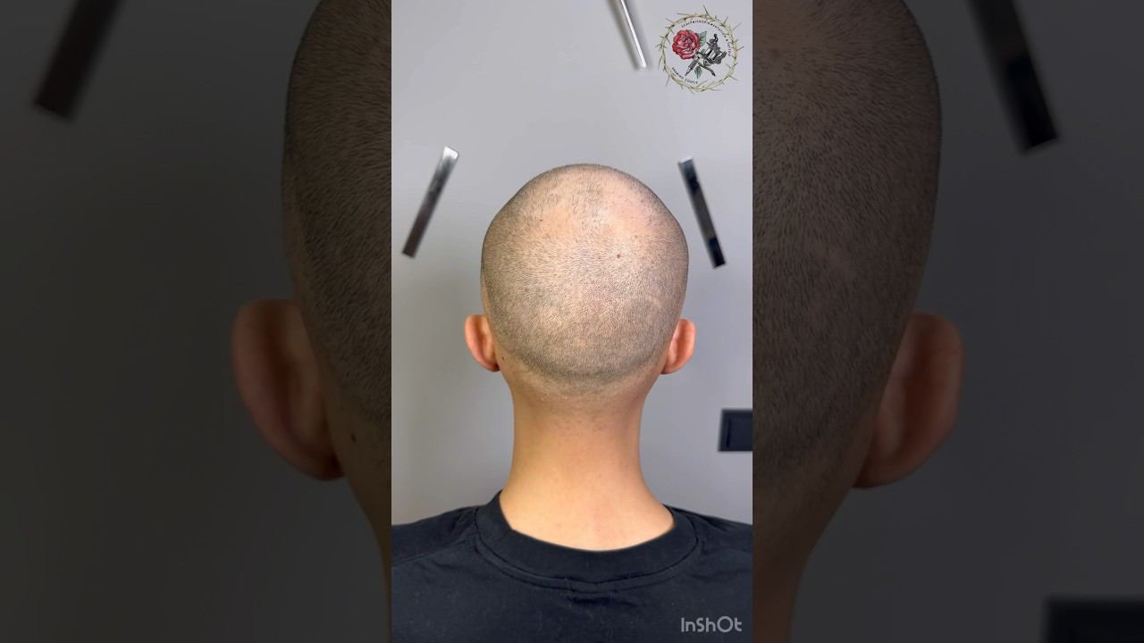 Маскировка облысения на затылке - трихопигментация, татуировка волос. SMP Scalp micropigmentation