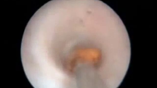 Дробление камней в почках смотреть онлайн