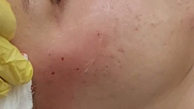 Заполнение скуловой области филлером для придания объема.