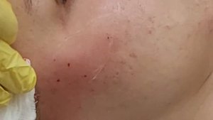 Заполнение скуловой области филлером для придания объема.
