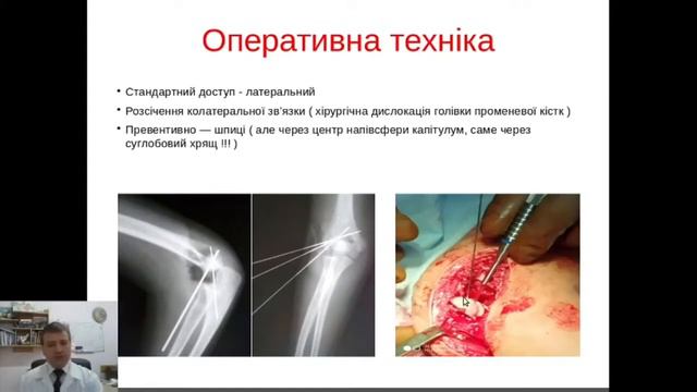 Лікування переломів дистального відділу плечової кістки у пацієнтів дитячого віку смотреть онлайн