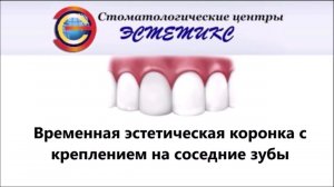 Временная эстетическая коронка с креплением на соседние зубы