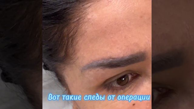 Прямой броулифтинг + липосакция подбородка смотреть онлайн