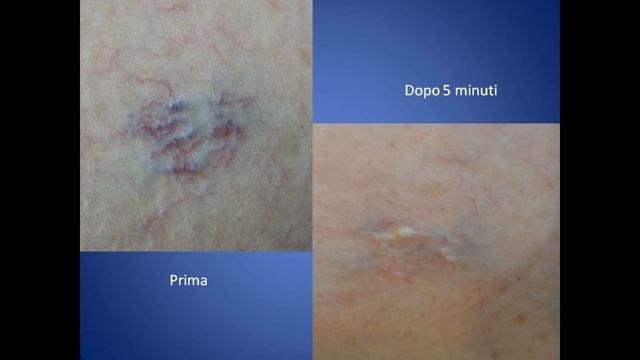 удаление сосдистых поражений на лазерной системе Velure S9 - 940нм смотреть онлайн