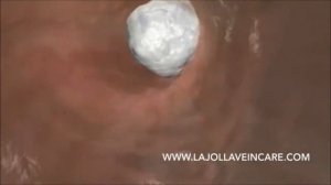 Склеротерапия